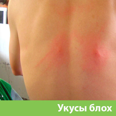 Укусы блох в Ялте