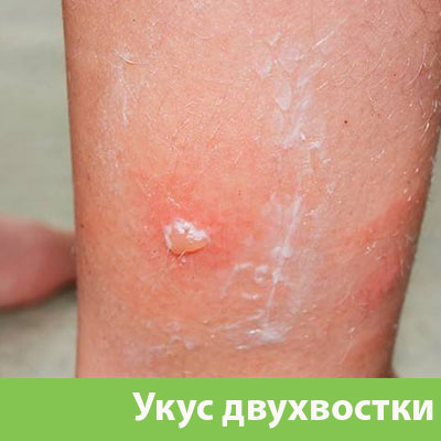Укус двухвостки в Ялте