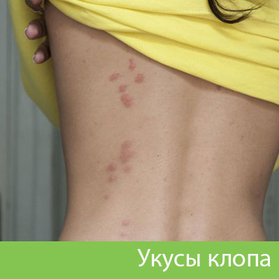 Профессиональное уничтожение клопов в Ялте